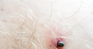 Första fallet av sällsynt fästingsjukdom i Finland